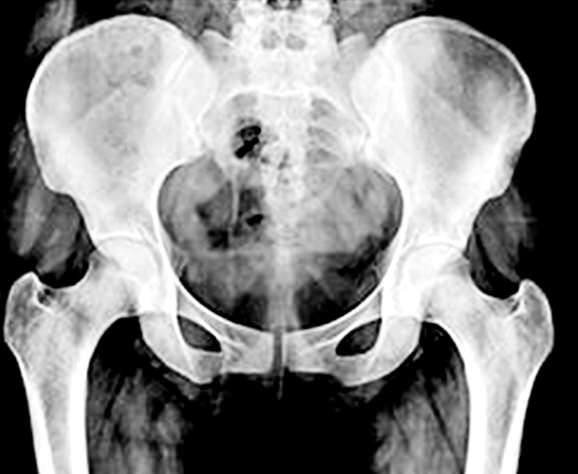 Physiothérapie du plancher pelvien : traitement ciblé et efficace pour les troubles pelviens